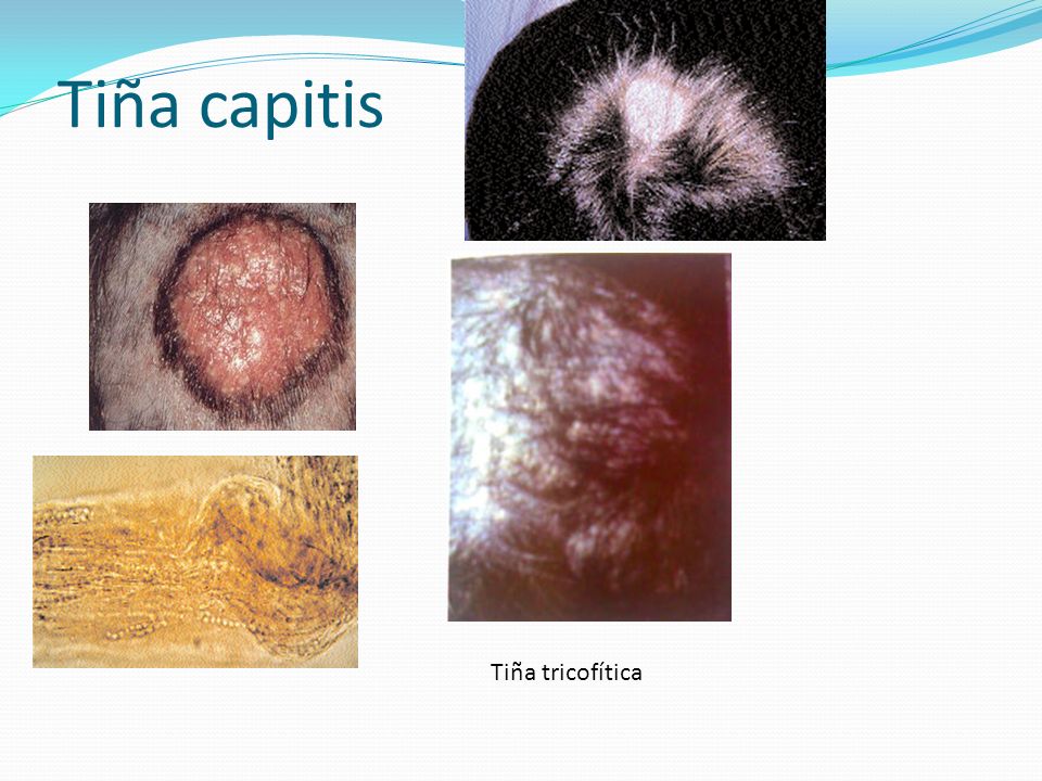 tiña corporis morfologia